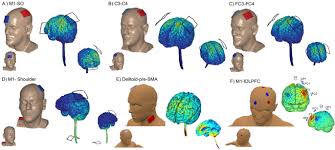 L12-  Parkinson Rigidez